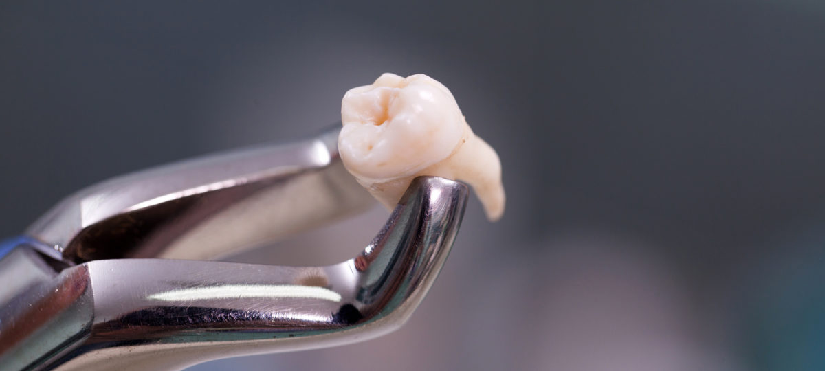 ząb szczypce 1200x540 - Czy zęby po ekstrakcji mogą się przesuwać?